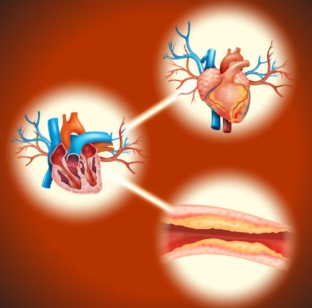 7 Subtle Signs of Clogged Arteries You Shouldn’t Ignore