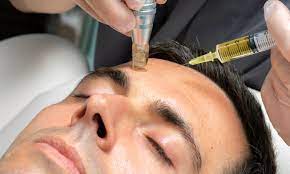 Microneedling for Hair Growth: A Potential Solution for Hair Loss