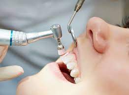 dental hygiene treatment in Dubai