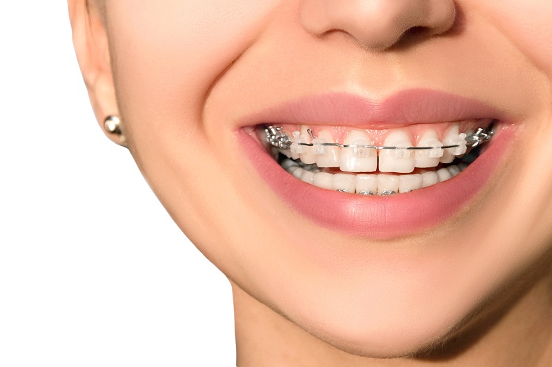 Affording a Perfect Smile: How Much Do Braces Cost in Houston?
