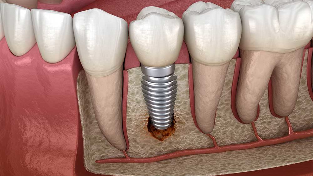Burlington Dental Implants