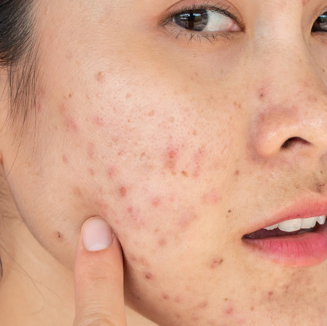 7 Powerful Natural Ways to Get Rid of Acne