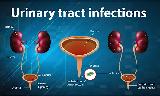 Everything You Need To Know About Urinary Tract Infection in Men