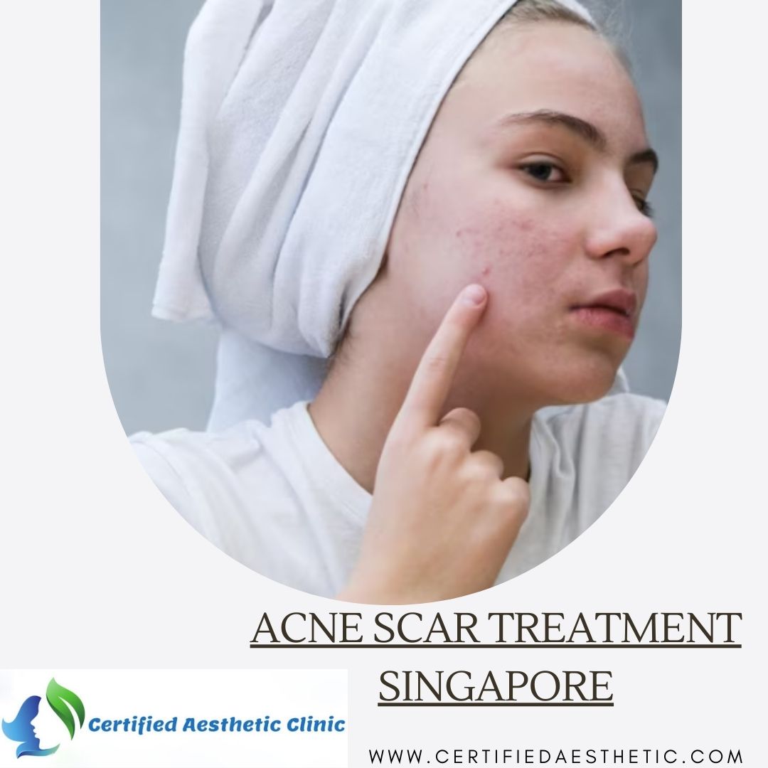 acne scar treatment singapore