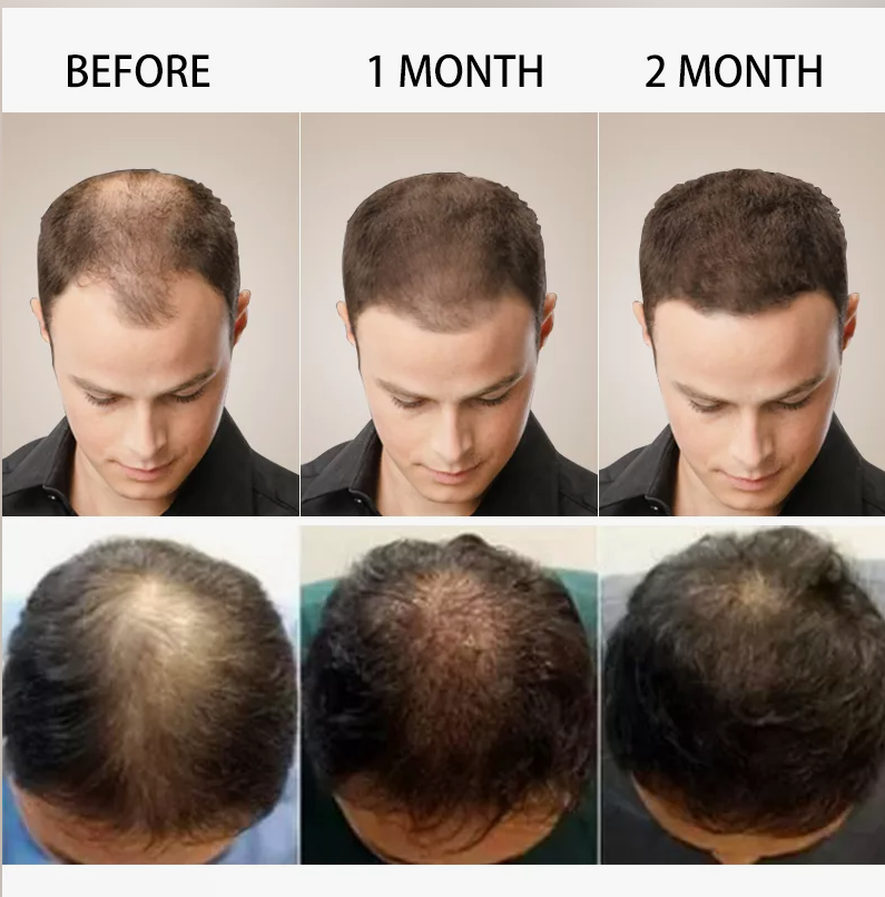 How Long Do PRP Results Last and Common: PRP for Hair Loss