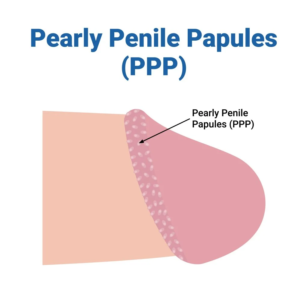 Penile Papules Treatment